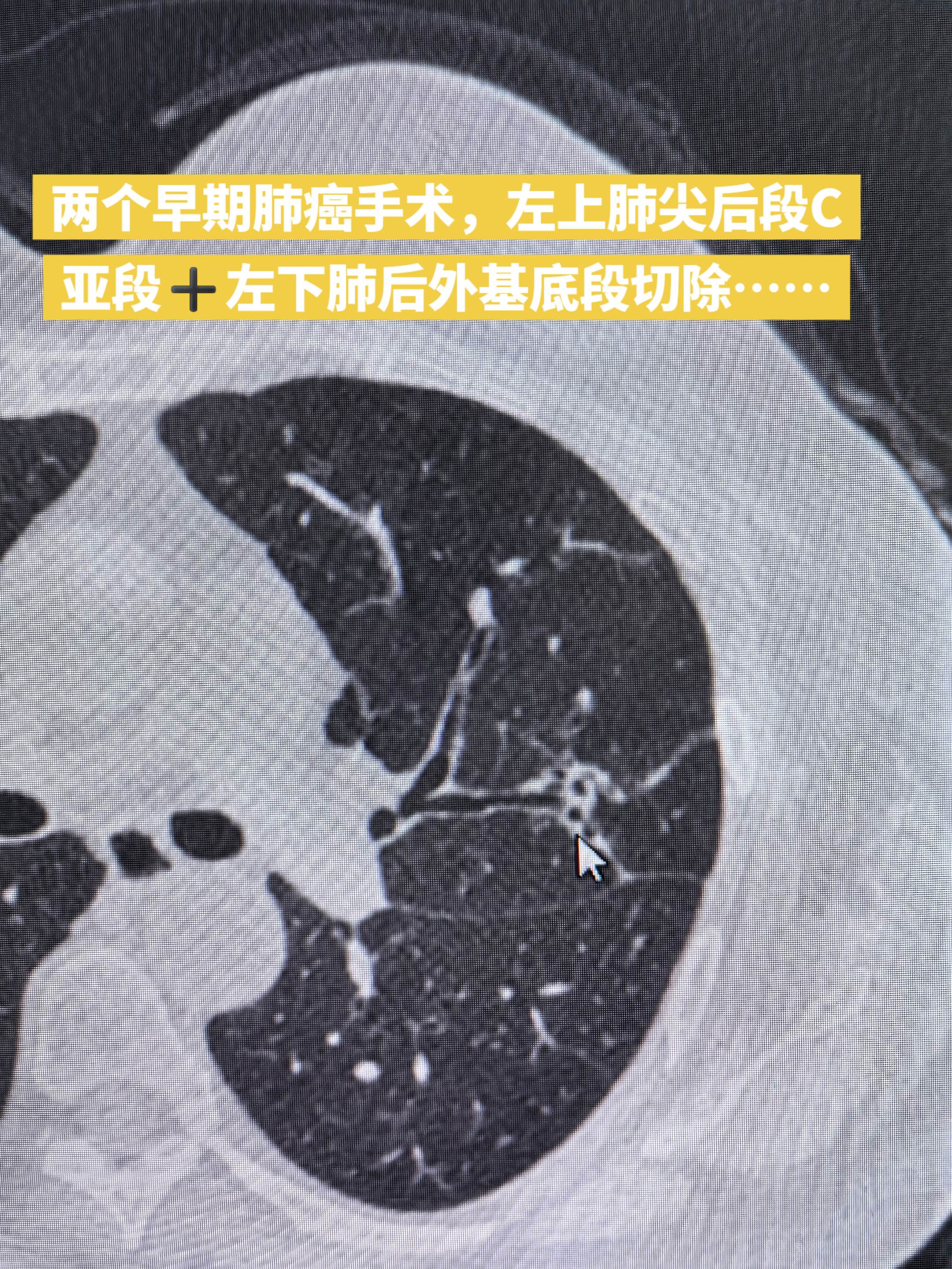复杂肺段切除……两个早期肺癌手术，左上肺尖后段C亚段➕左下肺后外基底段切除……