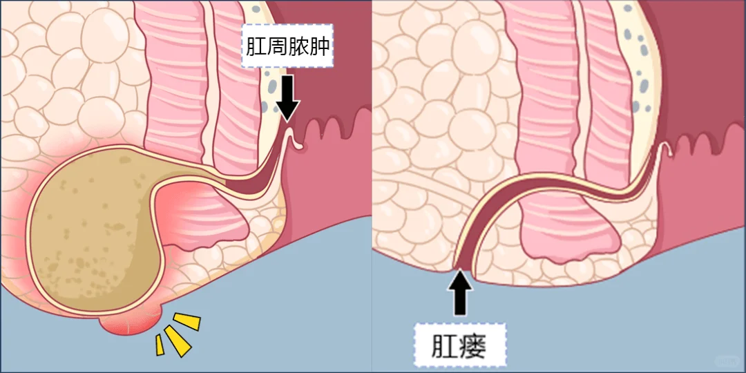 肛周脓肿 & 肛瘘复发率那些事儿❗