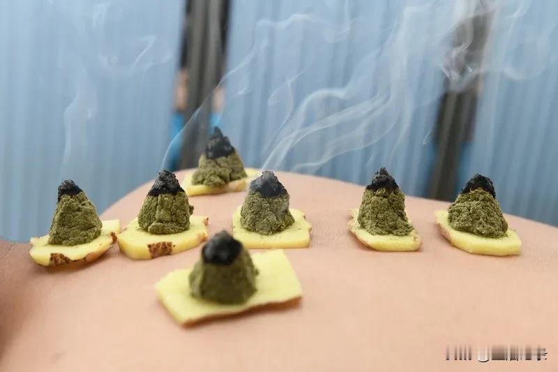 我借艾灸改善老寒腿症状。
每至秋冬，膝盖冷痛，
走路不便。
而后尝试艾灸，
选膝
