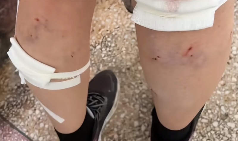 #平顶山学院回应流浪狗咬伤学生#【流浪狗咬伤学生的平顶山学院：曾发文明确校内流浪