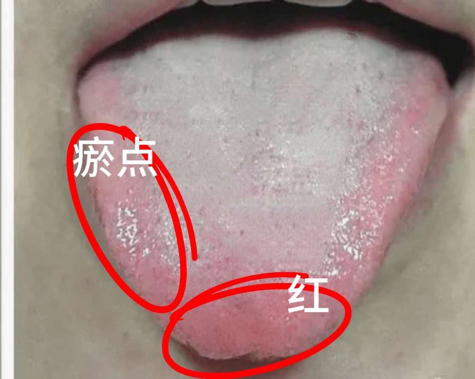 这种舌象，听我的话：千万别补！
因为这属于虚实交杂的体质，若只知道补虚，不祛邪只