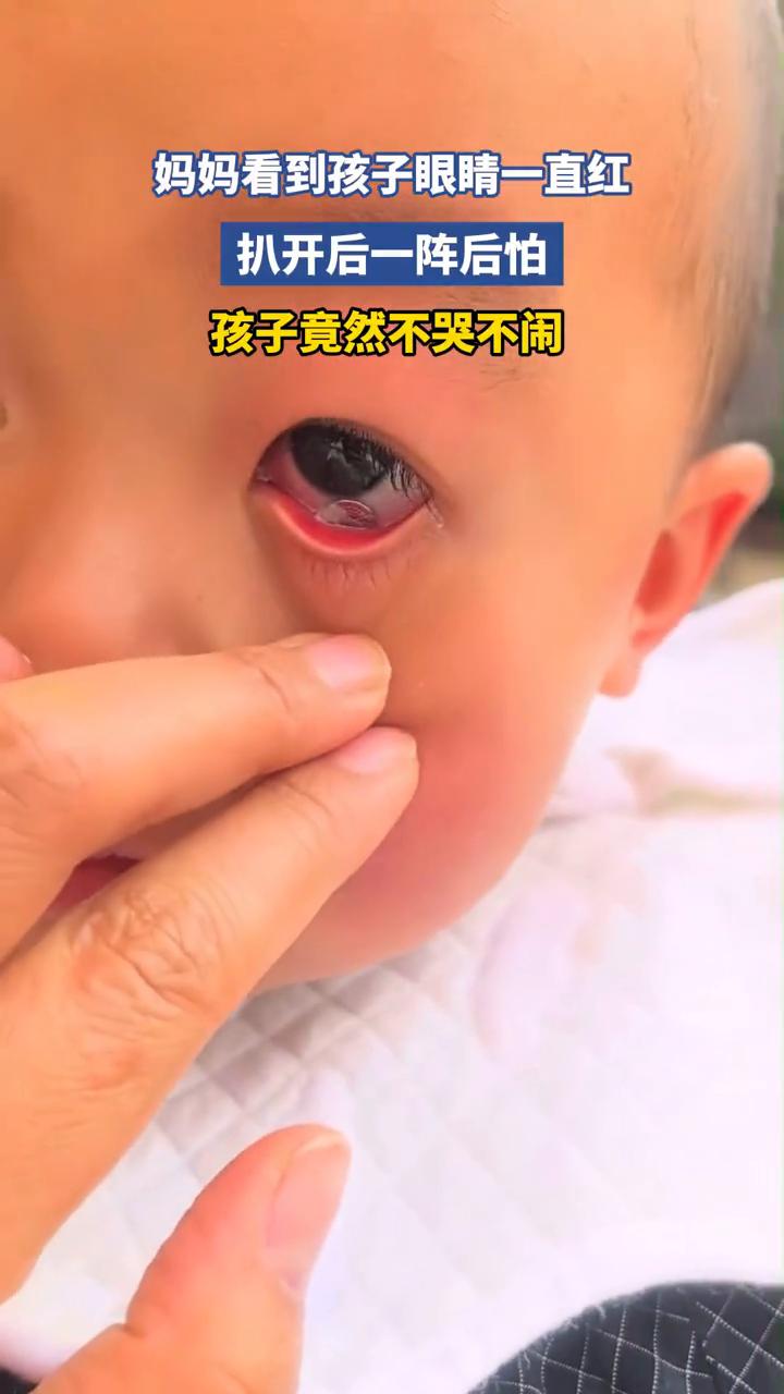 妈妈看到孩子眼睛一直红，扒开后一阵后怕，孩子竟然不哭不闹。
2月25日，河南郑州