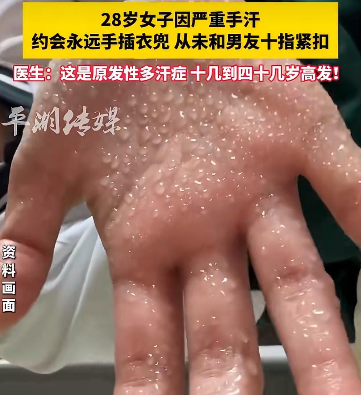 浙江平湖的女子小雅，因为患有严重的“原发性多汗症”，交感神经异常亢奋，导致她的手