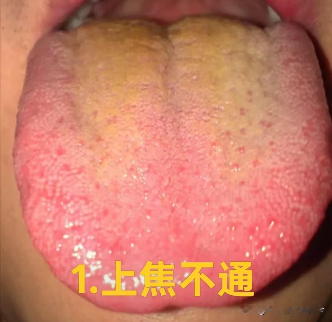 上焦不通心火旺 中焦不通人虚胖 下焦不通功能差 中医教你如何快速打通三焦

1.