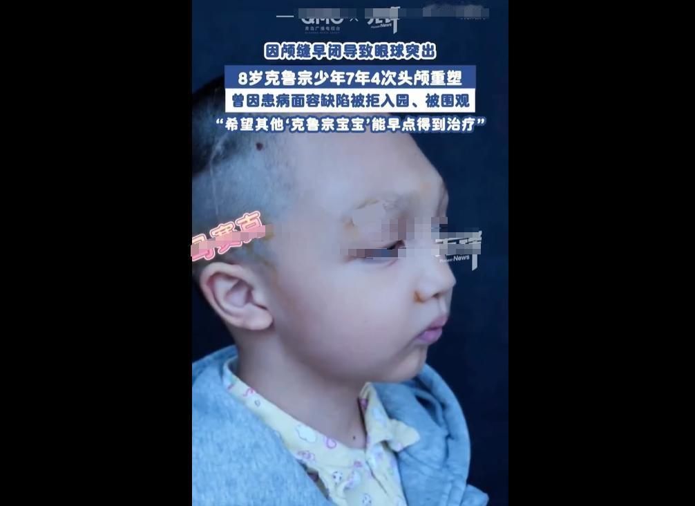 上海 8 岁男孩患罕见的克鲁宗综合征，因基因突变致颅缝早闭、眼球突出，遭幼儿园拒