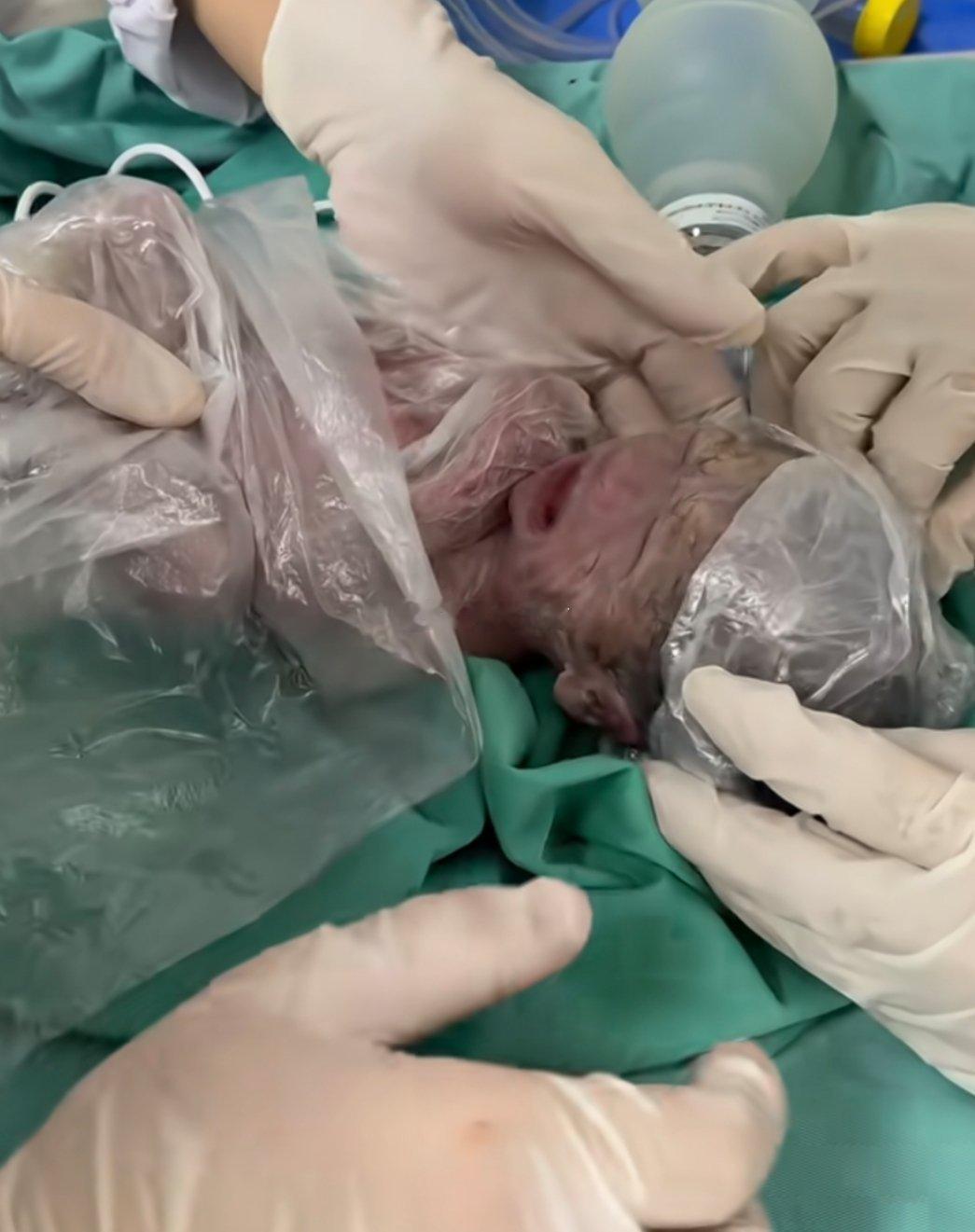 原来早产儿都是长这个样的？只希望他健康长大。 