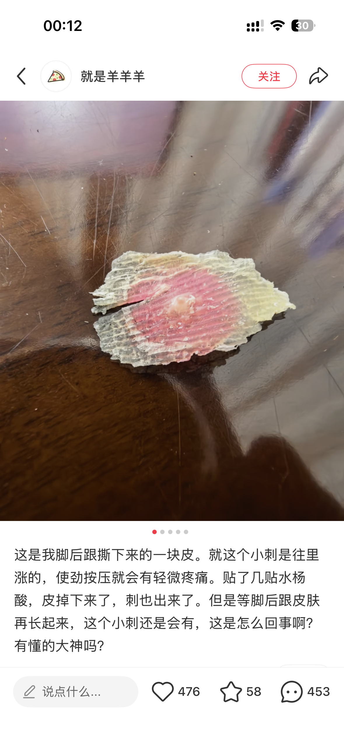 看房子看到一个笑的我满地打滚的帖子……有个人长了个鸡眼撕下来了，评论里吃薯片的人