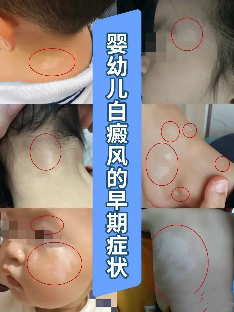 白癜风 白斑 白癜风科普 皮肤健康 抖出健康知识宝藏