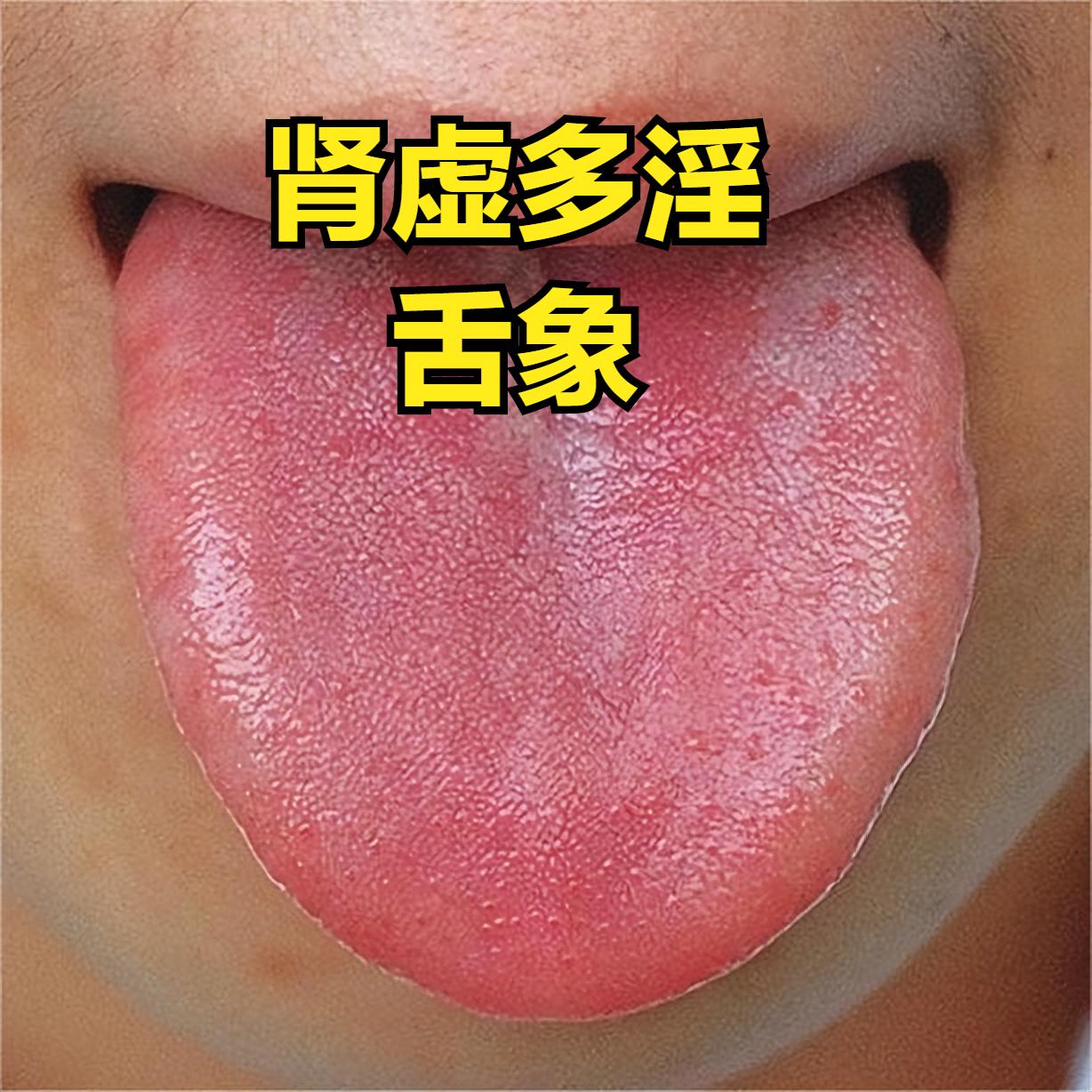 肾虚多淫，脾虚腹泻，肝虚眼花，一定要记住这三个方子！
1. 肾虚多淫
原因：肾阴