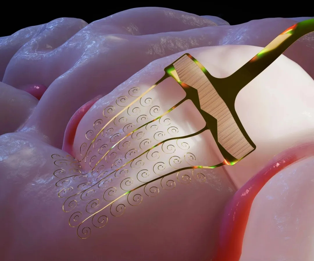 侵入式脑机接口企业智冉医疗半年连融两轮，总额超6亿元2月11日，国内侵入式脑机接