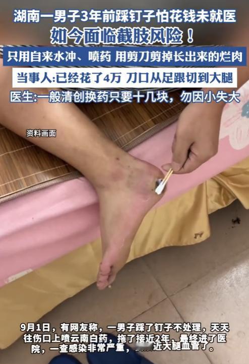 “这下后悔了！”2025年，湖南，一男子在3年前不小心踩到个钉子，怕花钱没有去医