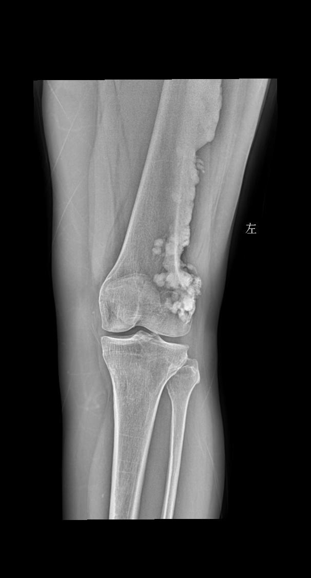 女 55 左侧关节疼痛
