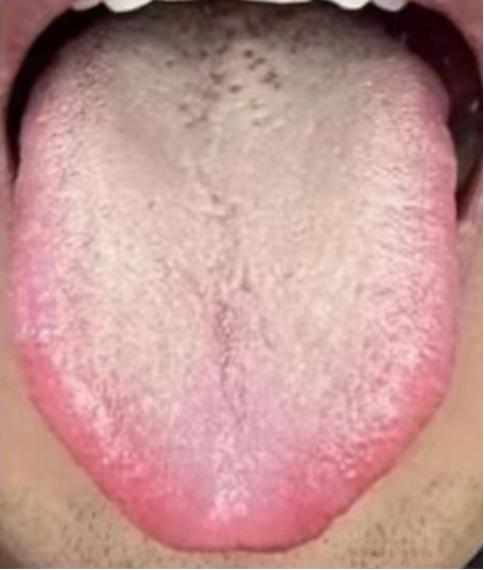 这种舌象，必定会有这三不好——房事不好，睡不好，吃不好
为什么这样说呢？接下来借