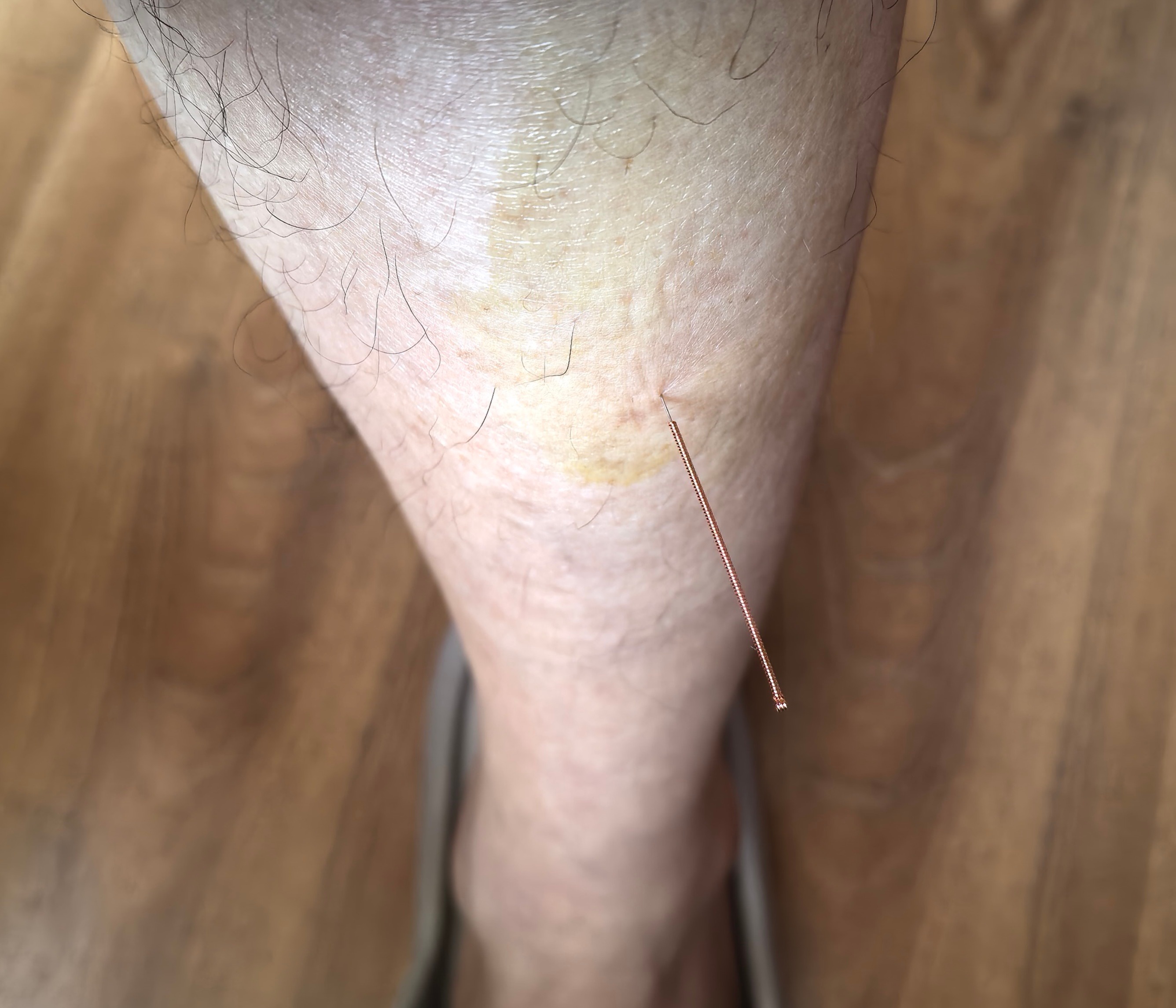 中医式生活 今天给父亲扎完针，也给自己扎了一针。这一针是刚学的，这个穴位叫“肩痛