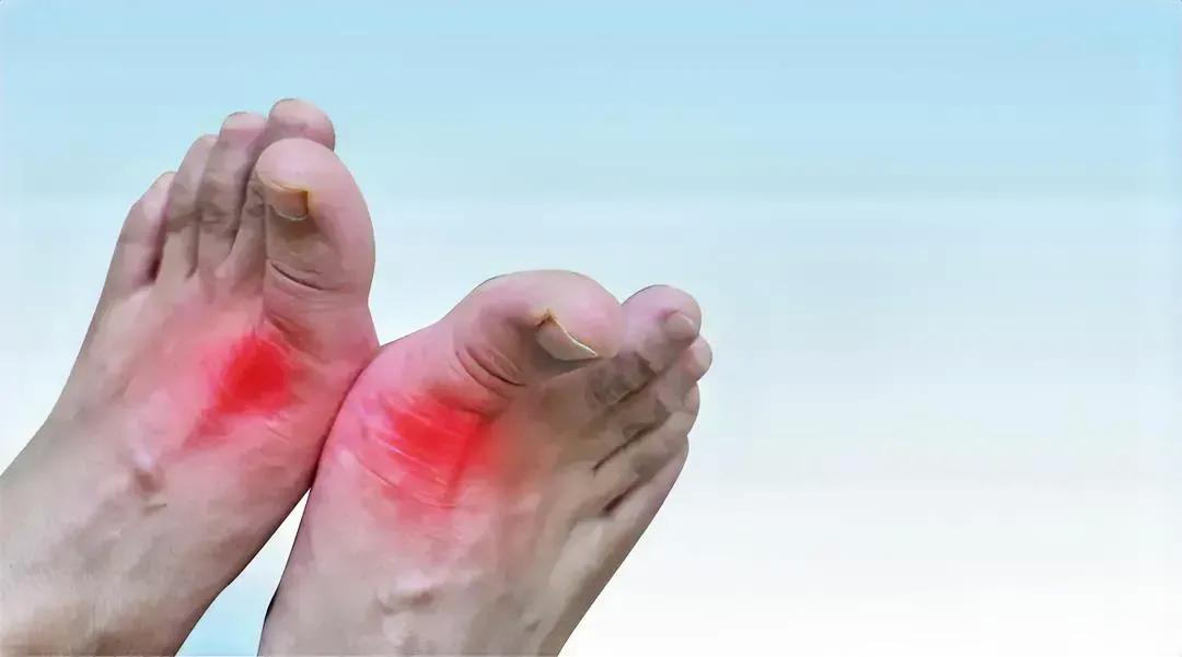 痛风为什么久治不愈？医生:  大多数人犯了这4个错误！痛风是一种慢性代谢性疾病，