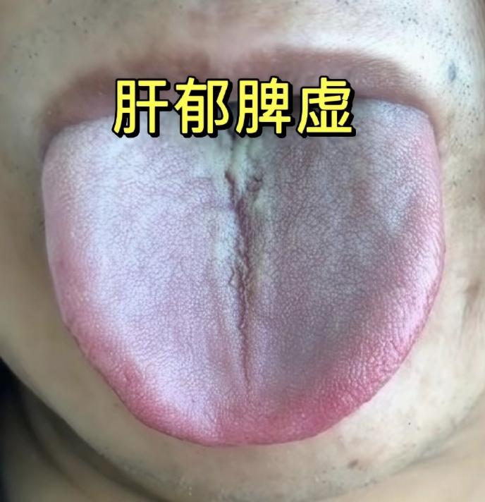 肝郁脾虚的舌象、成因和症状对应得特别准！舌头两边红胀（肝郁）+ 舌中间裂纹（脾虚