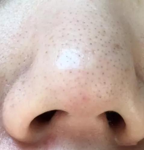 鼻子上的“黑头”加强清洁可以解决吗？真正的黑头是指黑头粉刺，属于痤疮。大家常说的
