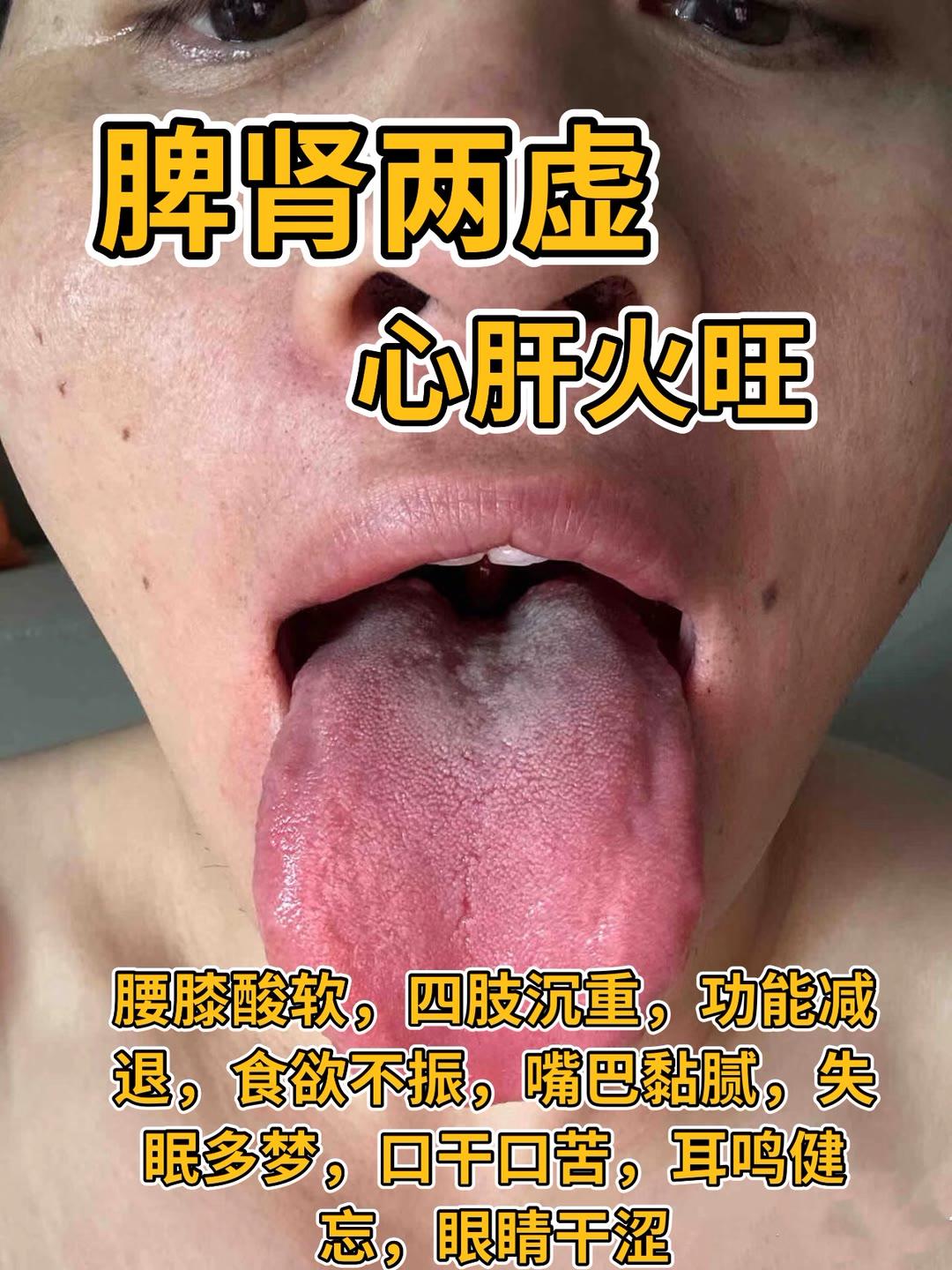 1.脾肾两虚  2.肾气不足 脾虚湿盛 3.肝肾阴虚 湿热下注
这几个是几个粉丝