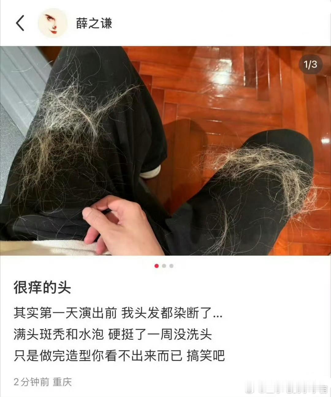 薛之谦自曝满头斑秃和水泡薛之谦发文分享因漂染导致脱发，满头斑秃和水泡，看完感觉鸡