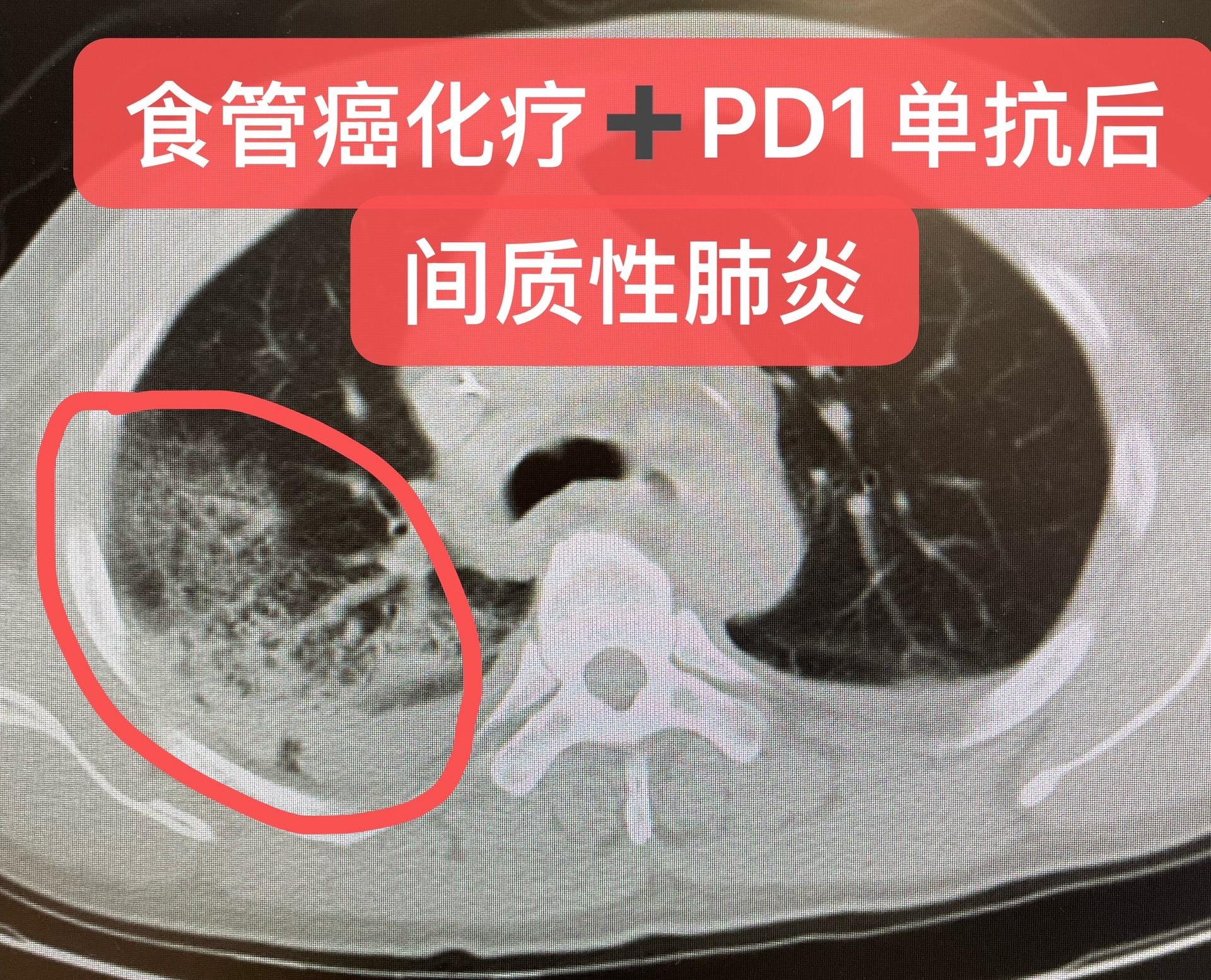 食管癌化疗➕免疫后，严重肺炎。食管癌化疗联合PD-1单抗后，出现间质性...