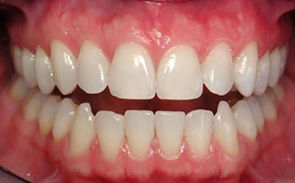 有人睡觉时磨牙，其实是一种比较常见的现象，医学上称为“夜间磨牙症”。这并不是因为