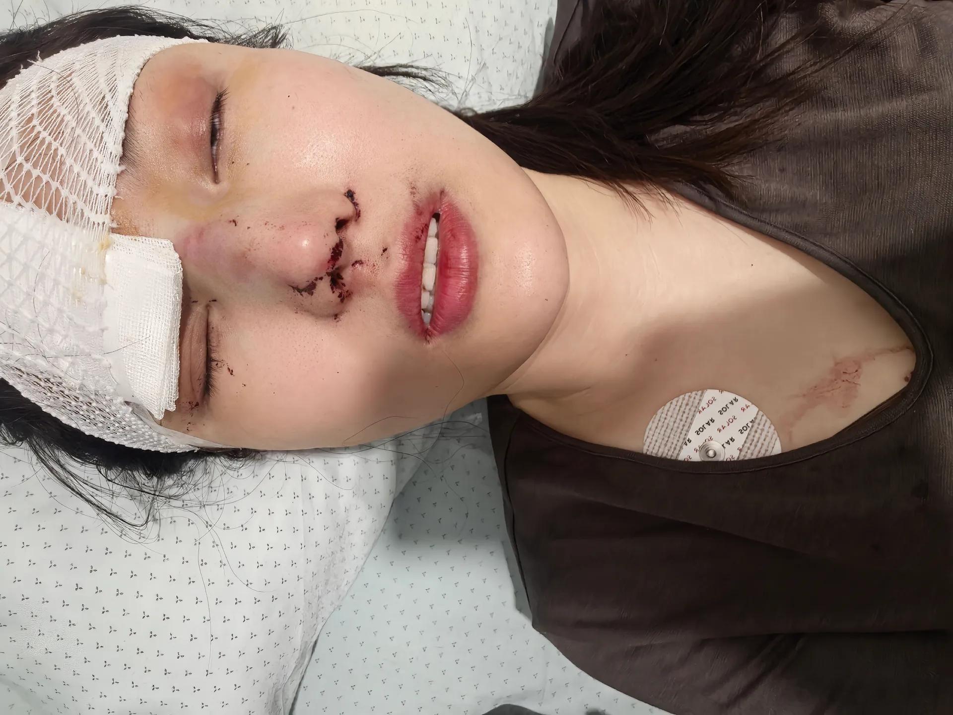 消失许久的任晓艺突然发文，一场惨烈车祸车上9个安全气囊全部炸开，侥幸生还却满身伤