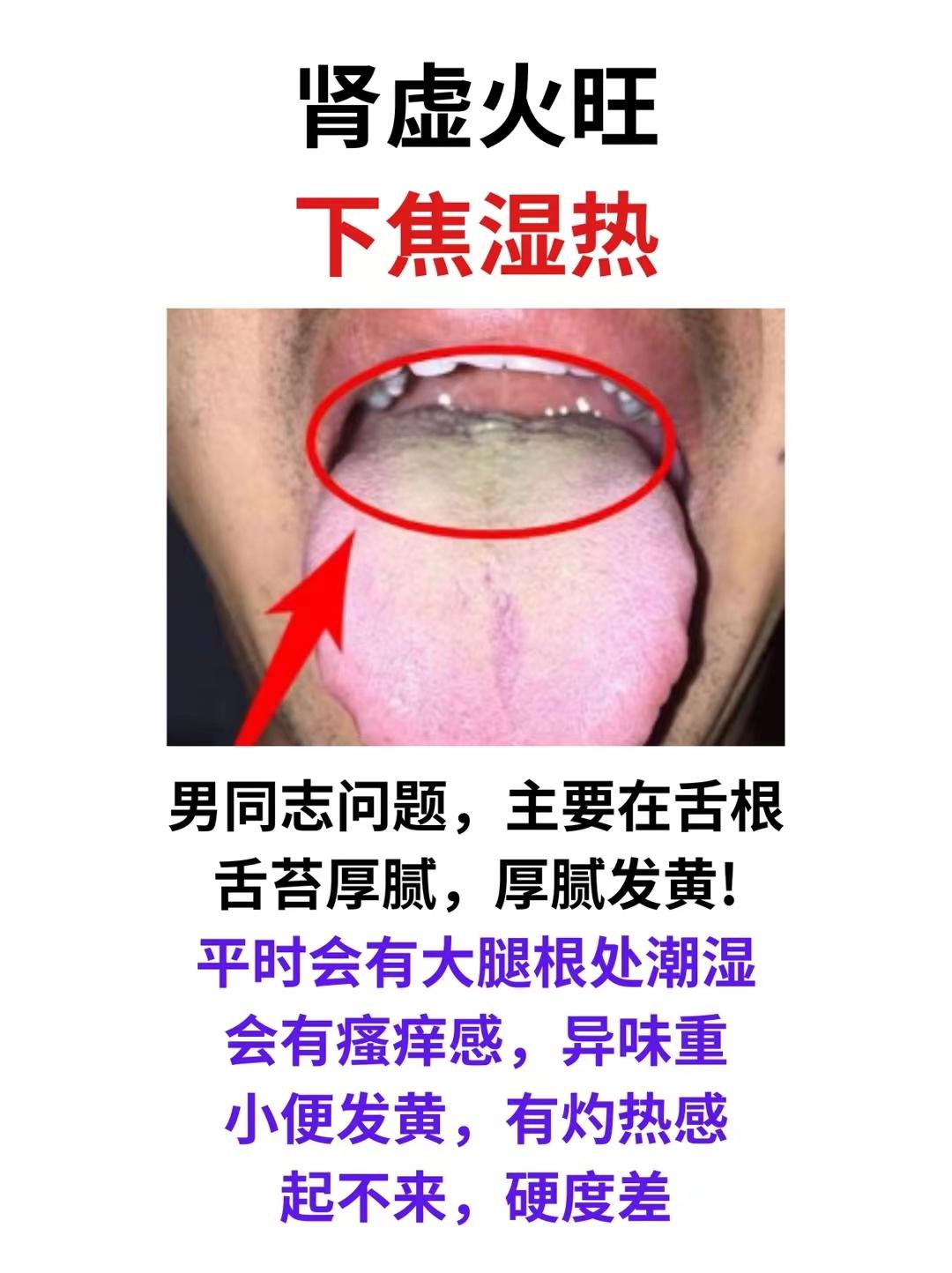 看舌就是看健康，舌诊操作简单，几分钟便可看出身体情况，今天潘医生分享3个病例，在