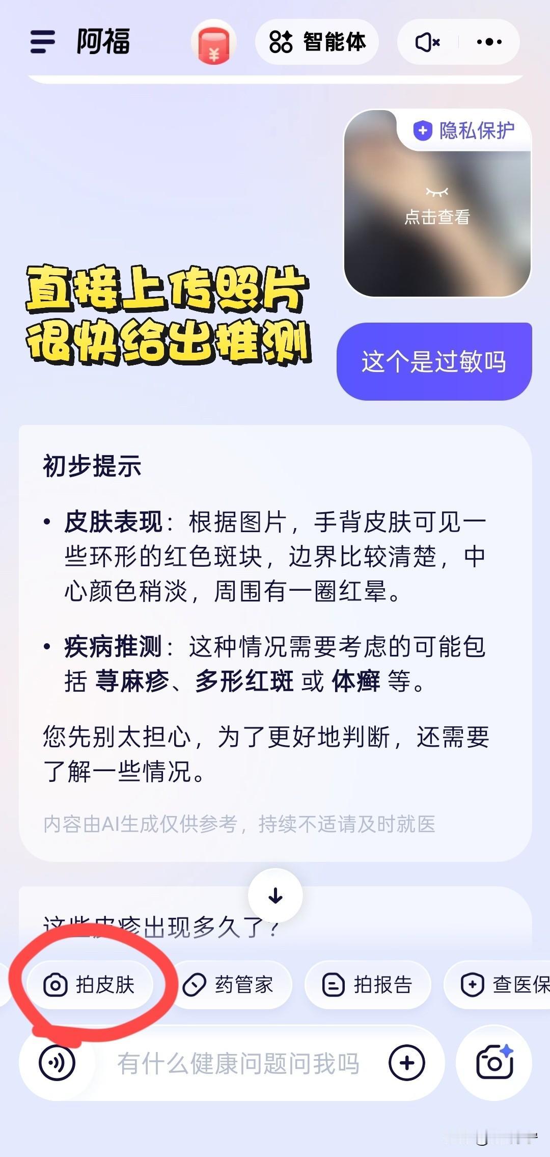 湿疹荨麻疹分不清？阿福帮你拍照识别

得过荨麻疹，才知道什么叫“痒得钻心”。我是