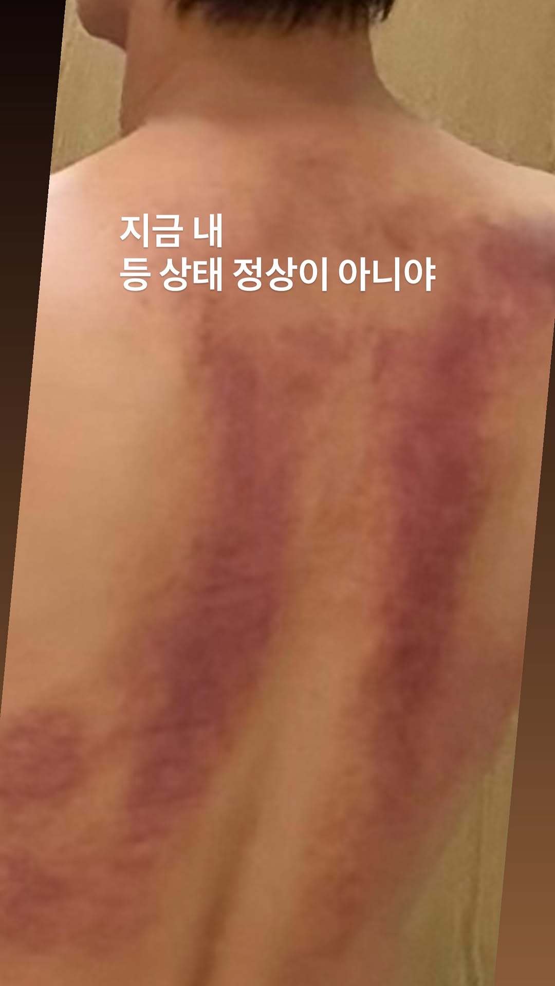 “CB百蓝_。260718利特 ins story更新：现在我后背的状态不正常 
