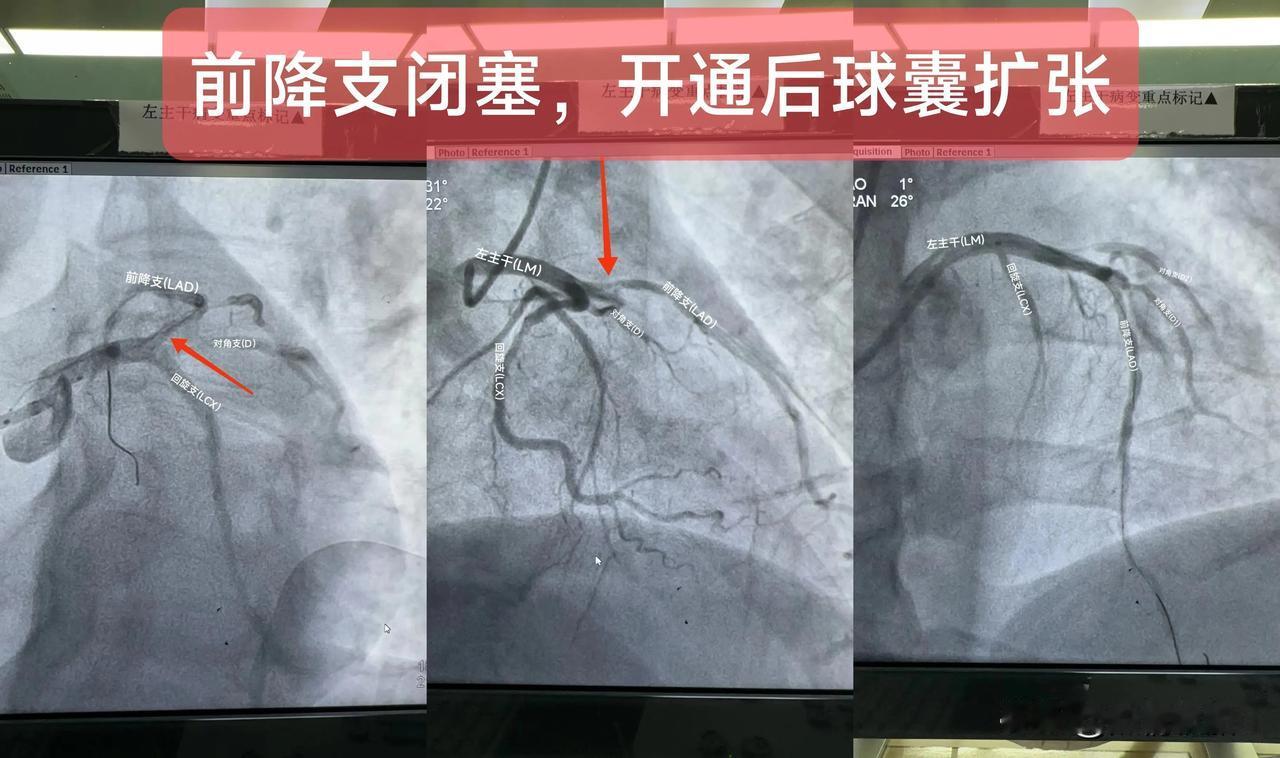 急性非ST段抬型心肌梗死
(前降支闭塞)
一.概念：
前降支主要为前壁及前间隔供