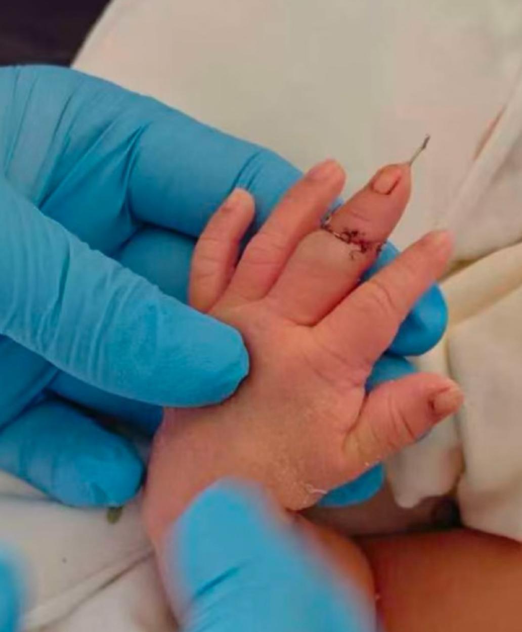 12月25日，张女士在江苏省盱眙县人民医院剖腹产分娩出一名健康男婴。然而，助产士