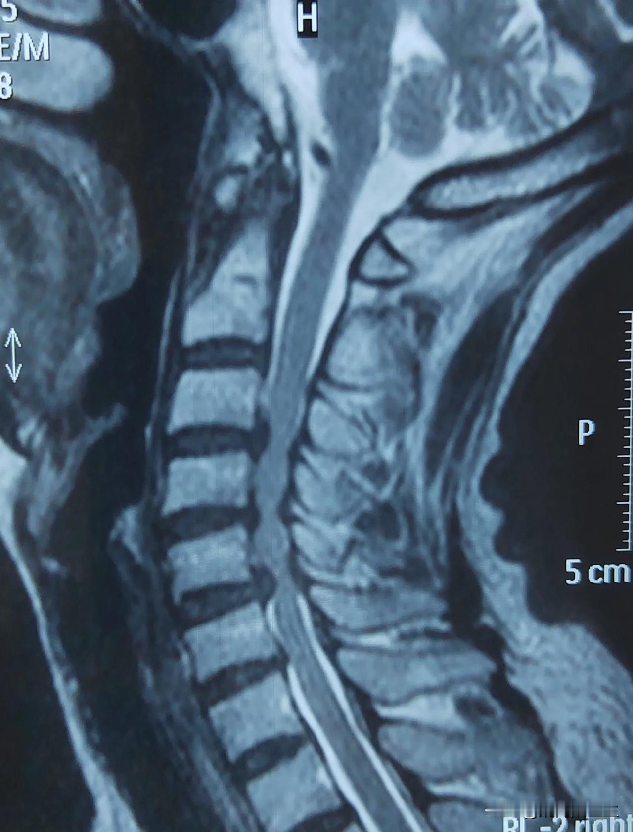 这样的颈椎病，脊髓都被压成糖葫芦啦。
做与不做手术，全在患者的承受能力。
有一点