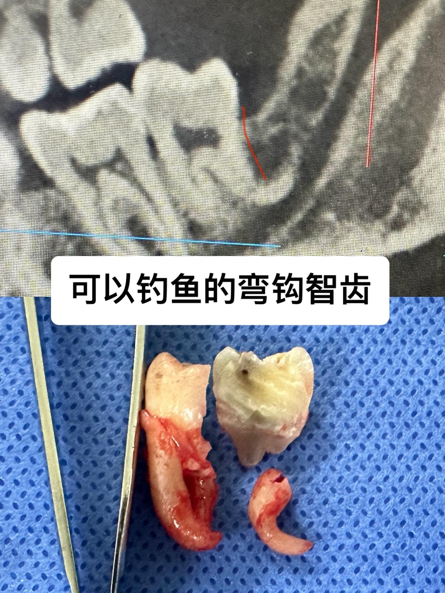 拔了一天的智齿，最开心的还是这颗垂直阻生，他去了好几个地方，都说拔不了。我说可以拔，但万一断一点点就不取了。
⚡上来直接分冠根，远中冠先出来，近中冠根也顺利脱位，使用弯的根尖挺尝试取出远中弯根，不能完全脱位，感觉再用力就会断掉。
⚡让助手拿了加长的固美车针，在远中根的远中稍微分了一下，牙挺旋转，完整脱位。