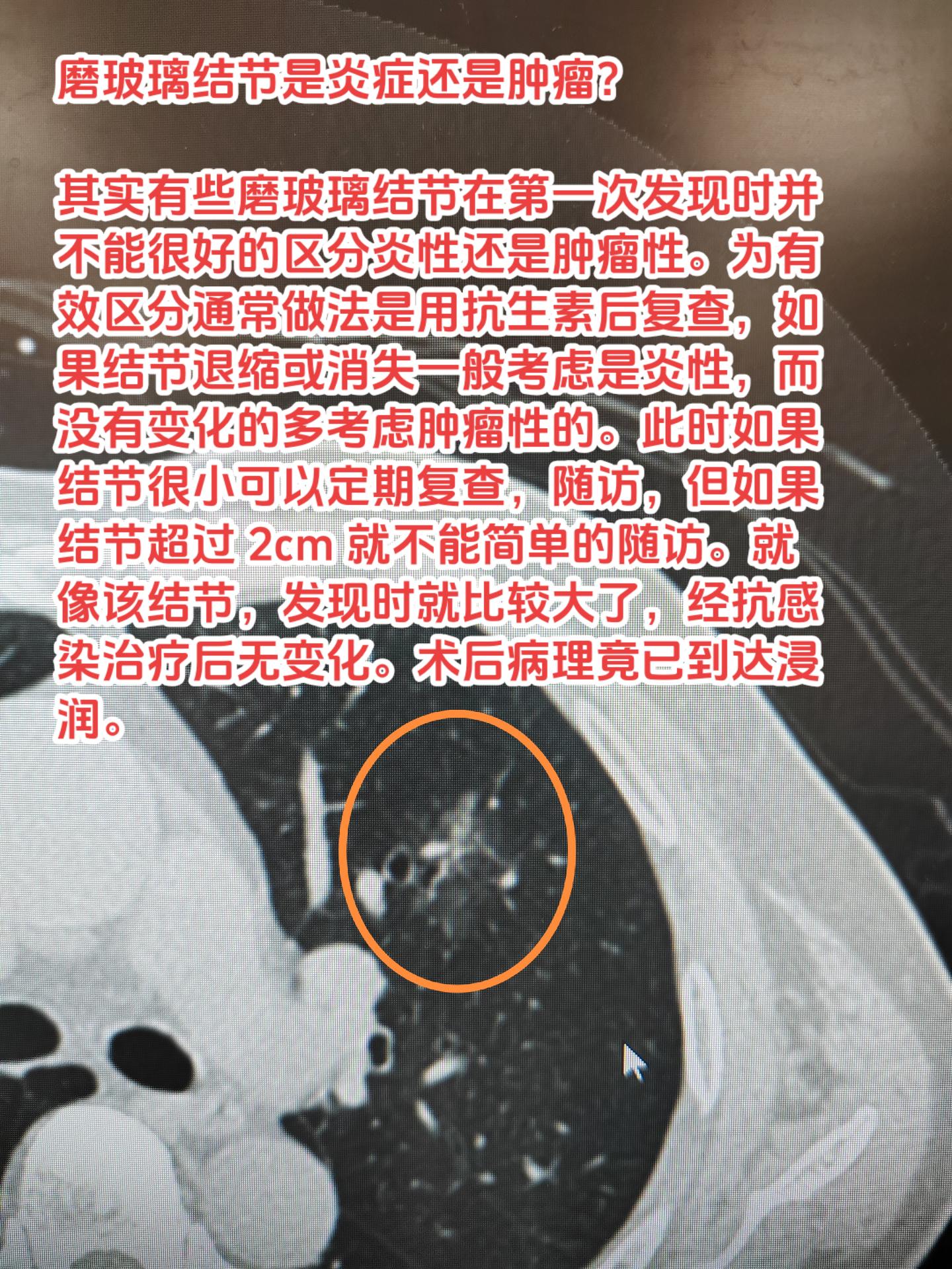 磨玻璃结节是炎症还是肿瘤？如何处理？其实有些磨玻璃结节在第一次发现时并...