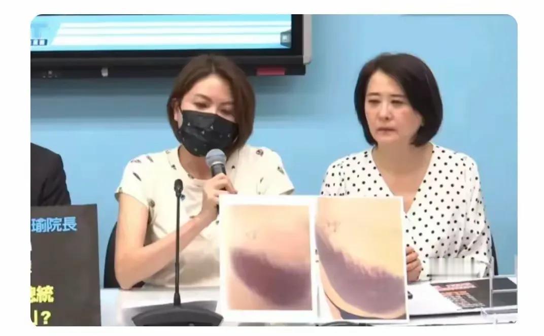 国民档蓝营今天举行记者会，陈菁薇公布证据照片，照片显示她臀部、腿部大片淤青，陈更