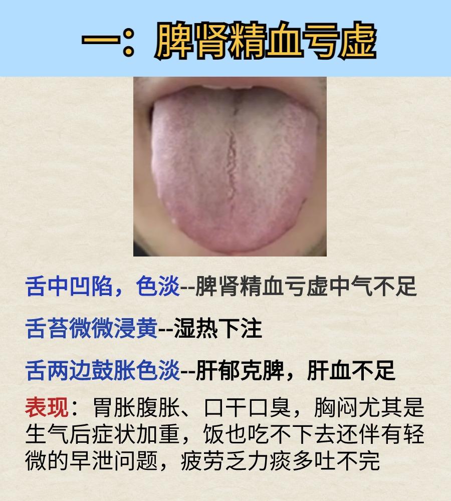 今日舌诊案例分析：脾肾精血亏虚，肾气亏虚、内火旺，肝郁化火