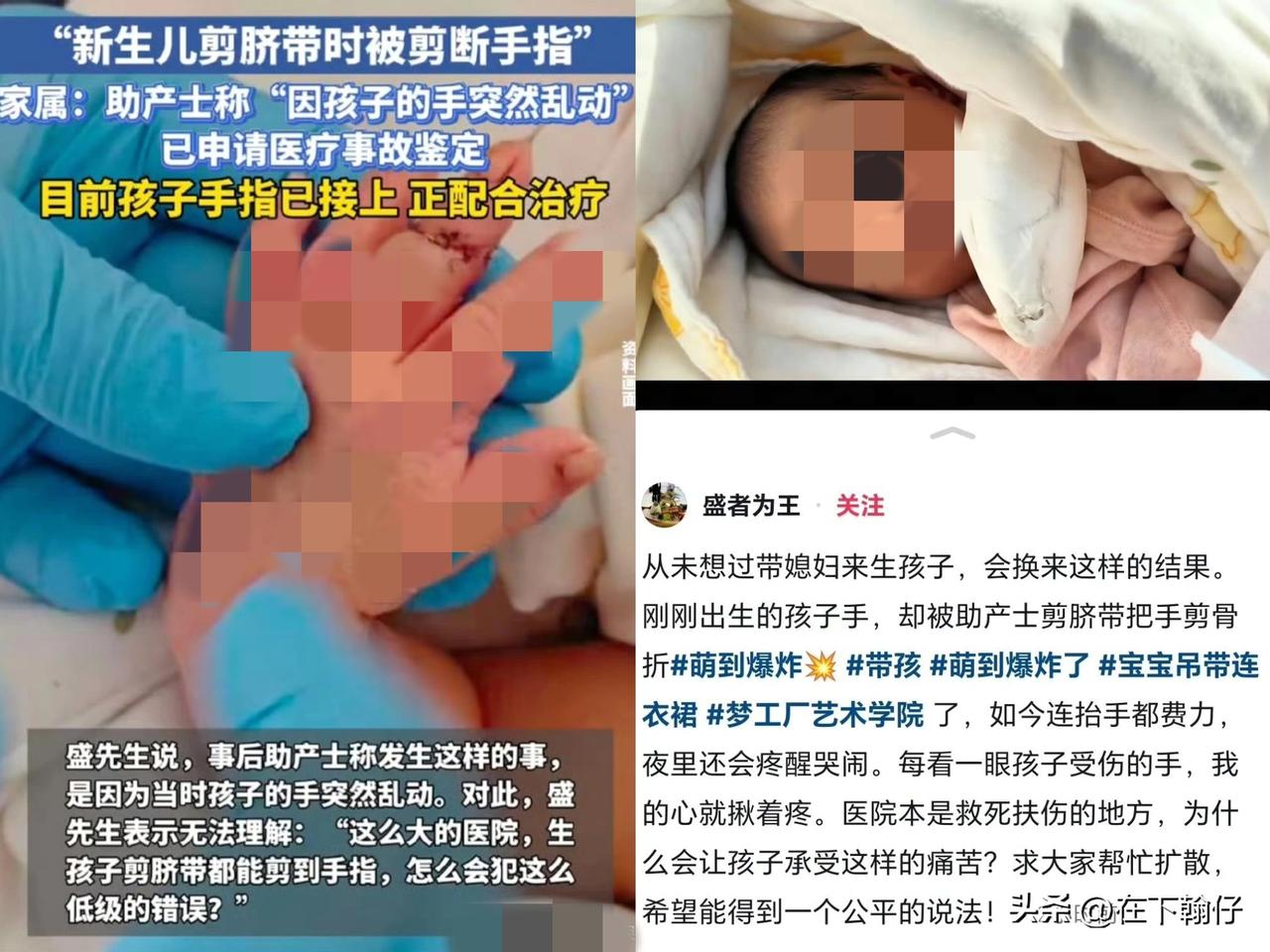 江苏一名新生儿在剖宫产剪脐带时左手中指被助产士误剪断，父亲公开发声质疑医院操作过