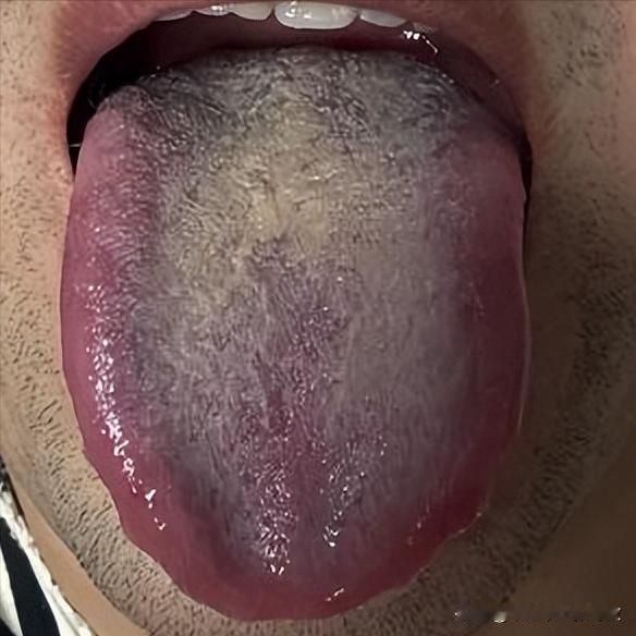 大兄弟，舌头都烧成这样了，你这火也忒大了[捂脸][捂脸]
主诉：总是口渴，晚上经