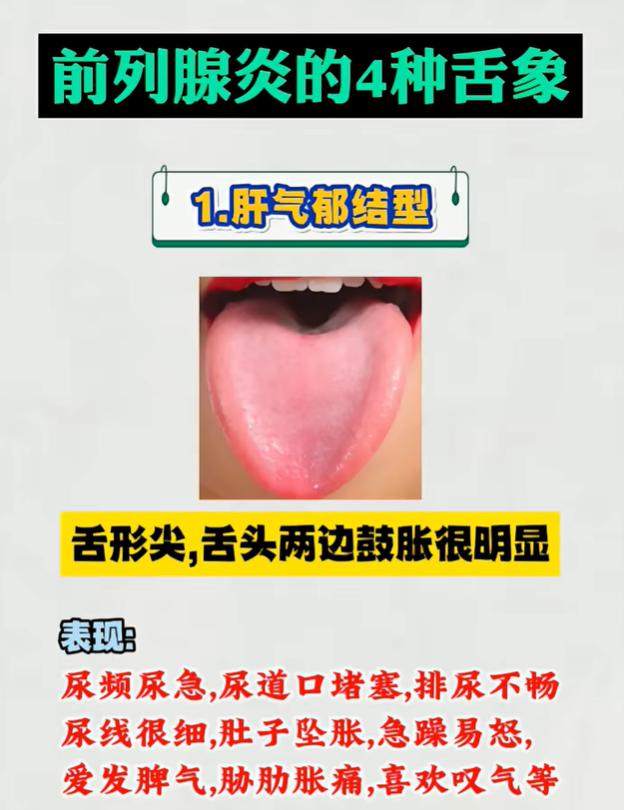 尿频反复别盲目调理！4 种舌象，分清肝郁、湿热、血瘀、肾阴虚