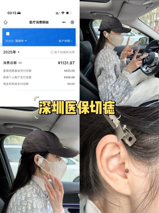 深圳医保切痣下车，自费0