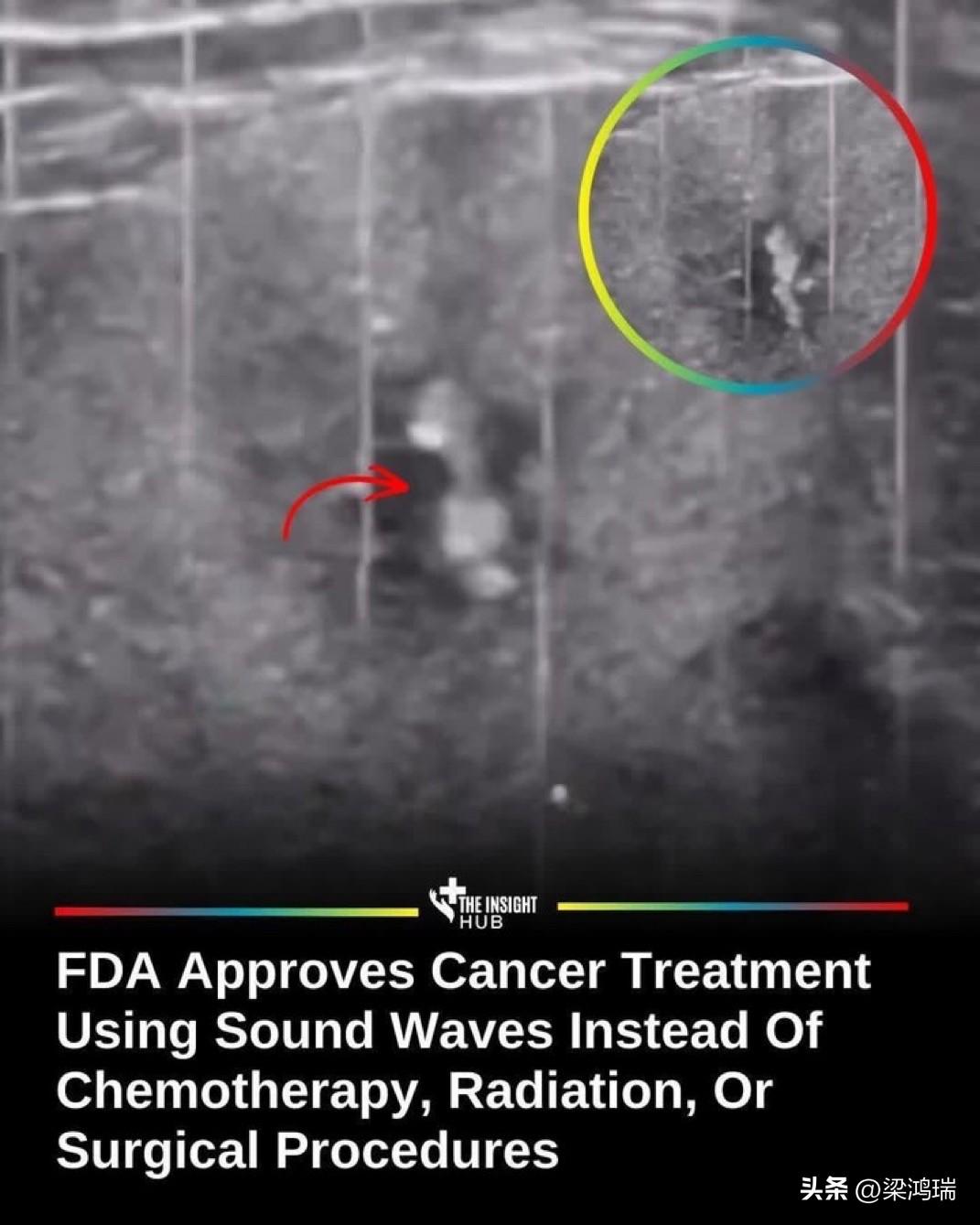 美国食品药品监督管理局（FDA）批准了一种新型癌症疗法，该疗法利用聚焦声波靶向肿