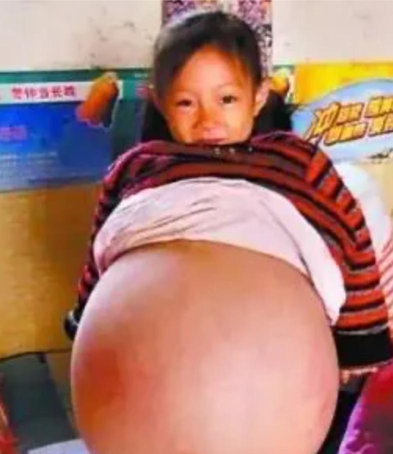 2010年，山西4岁女孩胡云星，肚子超大鼓胀得像孕妇。医生预言活不过三个月，就在