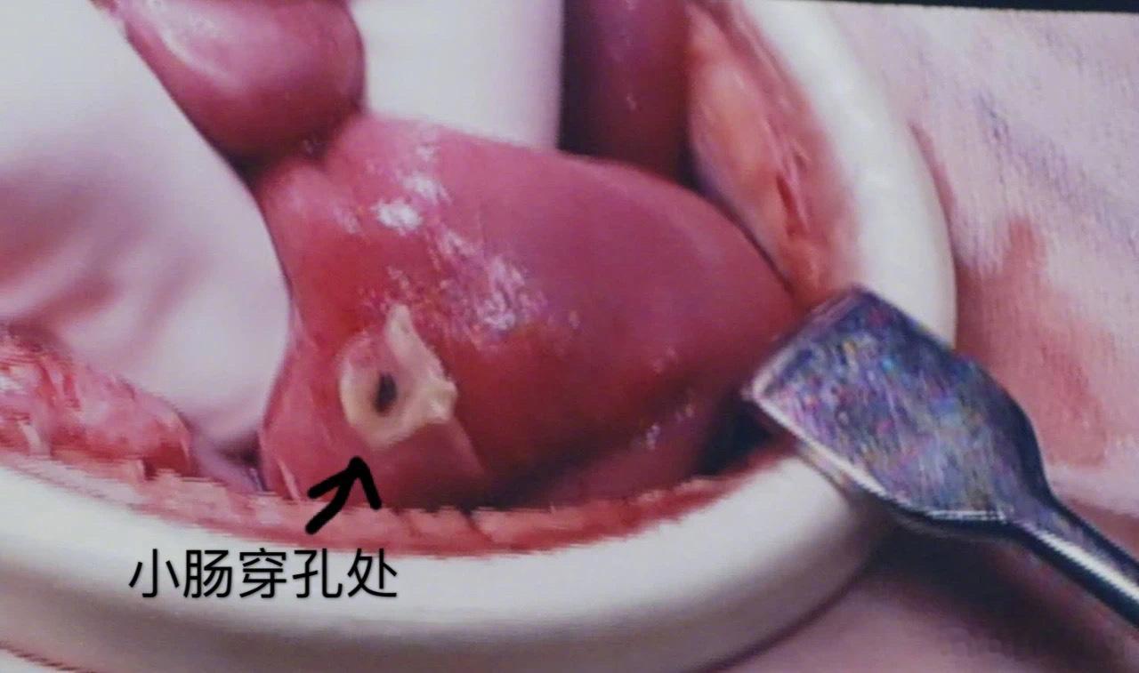 漂亮小姑娘吃完一个溏心蛋，历经一场生死劫。每年7月到10月，本病最高发，因此，我