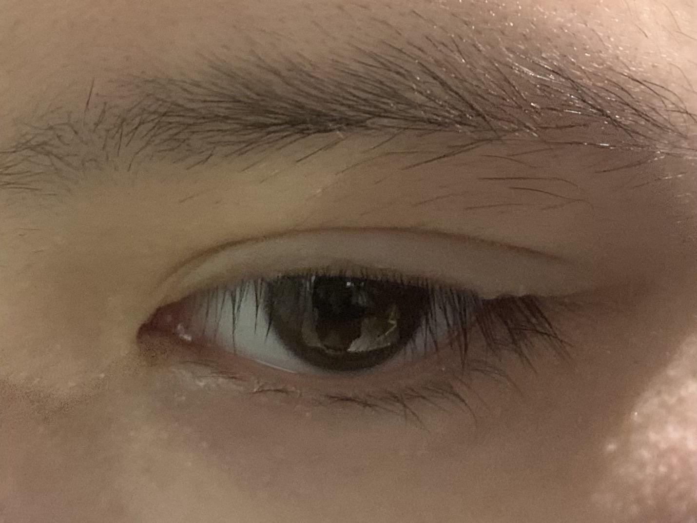 噶双眼皮前后