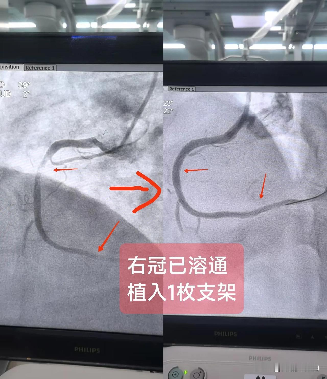 急性ST段抬高型心肌梗死
（右冠溶栓己通)
一.概念：
右冠状动脉起自右冠窦，经