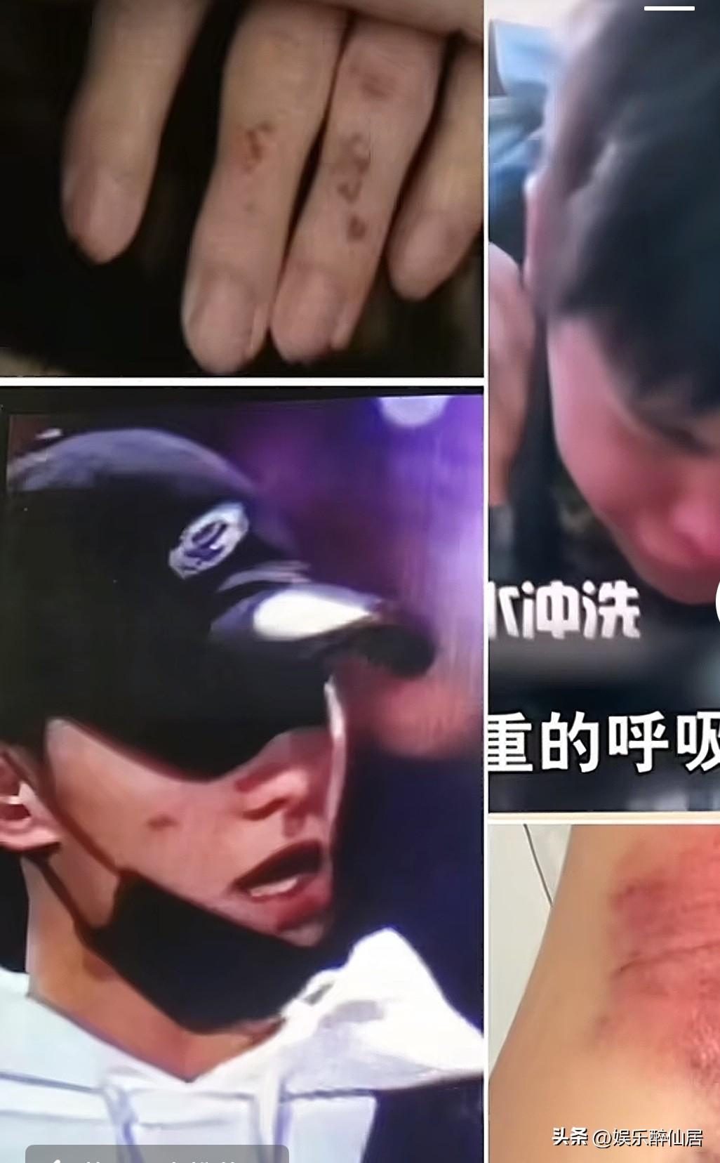 杨洋到底得罪谁了？
最近怎么看到他的新闻全是受伤之类的，还挺严重的，一直觉得杨洋