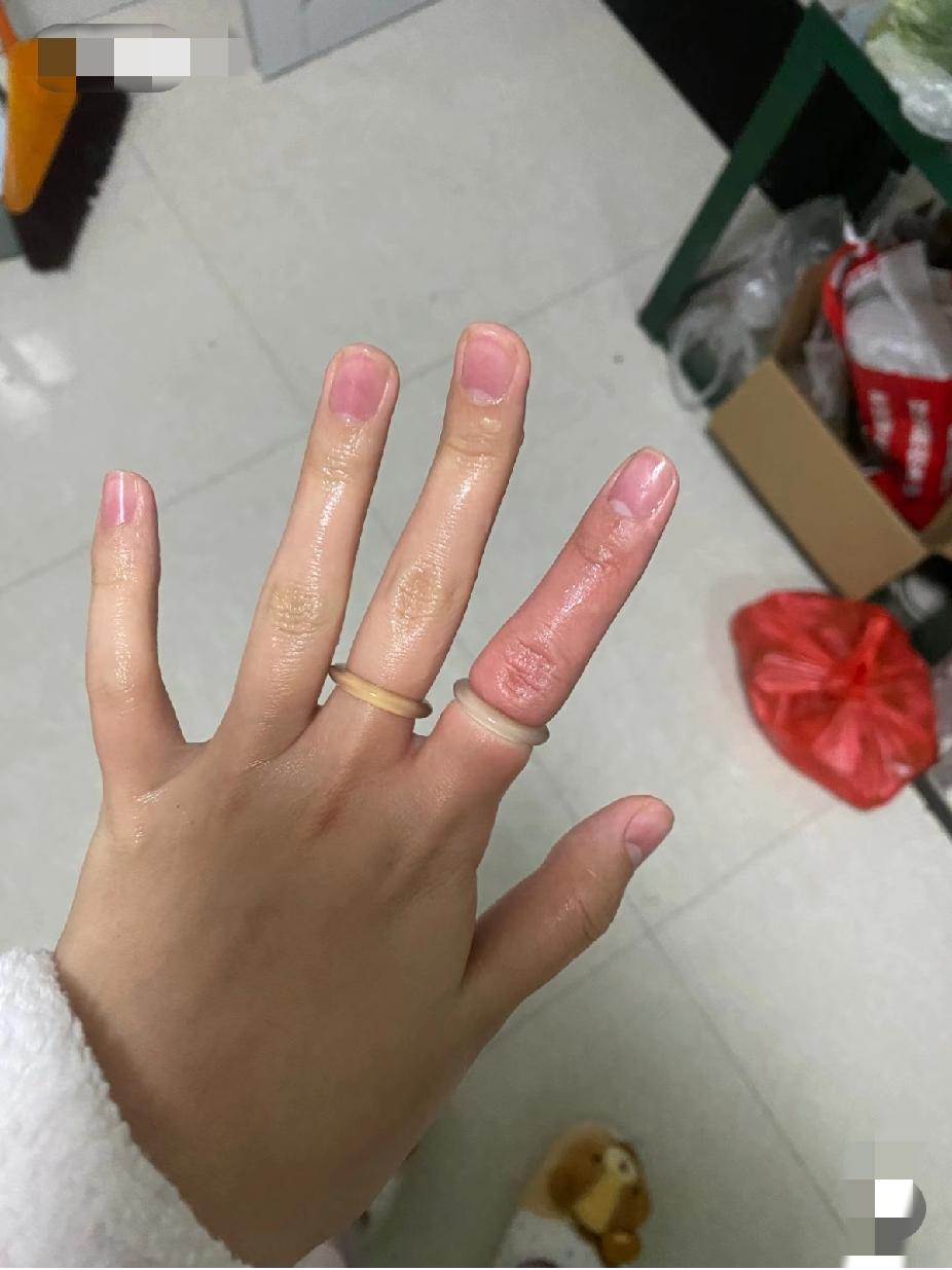 急！友友们帮看看，戒指取不出来了，疼哭了！该咋办？求大神支招！[泪奔]