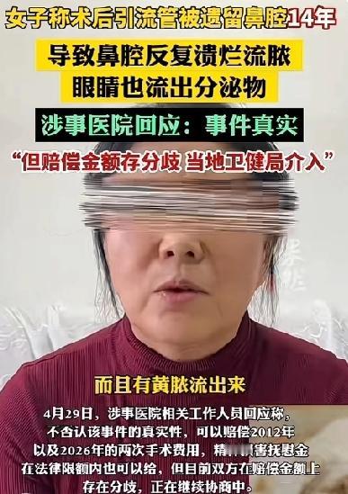 女子做完手术14年鼻子烂了、眼睛流脓，罪魁祸首竟是当年留在体内的2cm引流管！