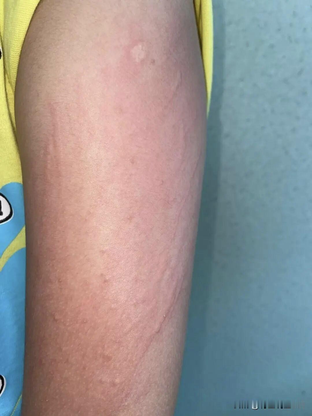 反复起风团瘙痒？5个经典中成药调理慢性荨麻疹，温和祛风不刺激，一文读懂
 
慢性