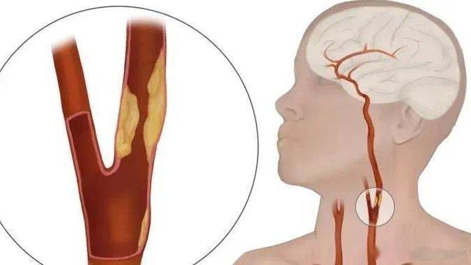 凤凰新闻【我国超2亿人有颈动脉斑块！研究证实：斑块可以消退！有5点建议】“颈动脉
